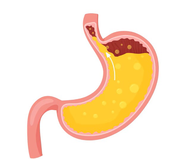 Imagem mostrando o ácido estomacal subindo para o esôfago, ilustrando o mecanismo da azia e do refluxo gastroesofágico