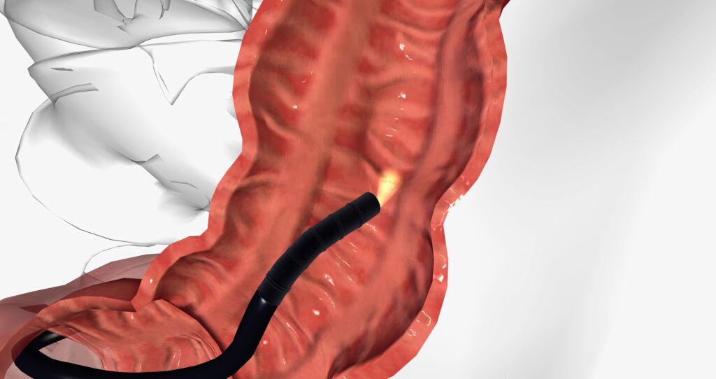 Ilustração médica mostra um endoscópio sendo inserido no interior do cólon humano durante um exame de colonoscopia. O tubo flexível, com uma luz na ponta, percorre o intestino grosso, que apresenta a superfície interna com pregas e coloração avermelhada característica da mucosa intestinal.