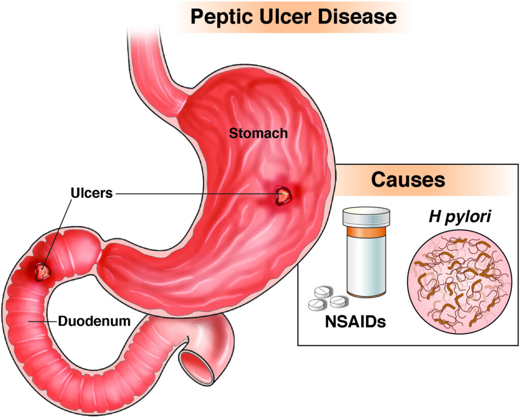 Ilustração de úlcera péptica mostrando o estômago e o duodeno com áreas ulceradas. Indicação das principais causas: infecção por Helicobacter pylori e uso de anti-inflamatórios não esteroides