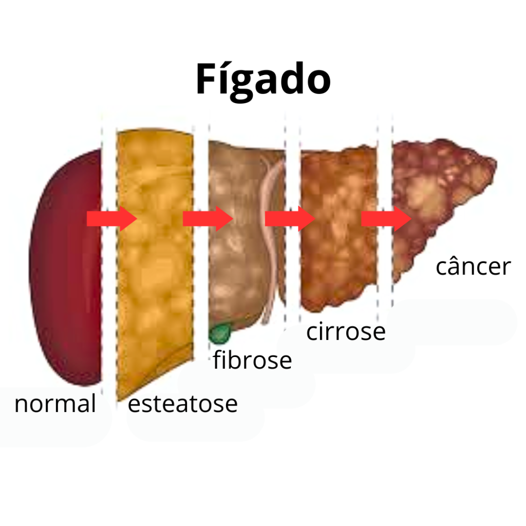 Ilustração mostrando a evolução do fígado: normal, esteatose, fibrose, cirrose e câncer.