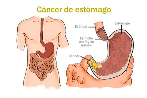 Câncer de estômago